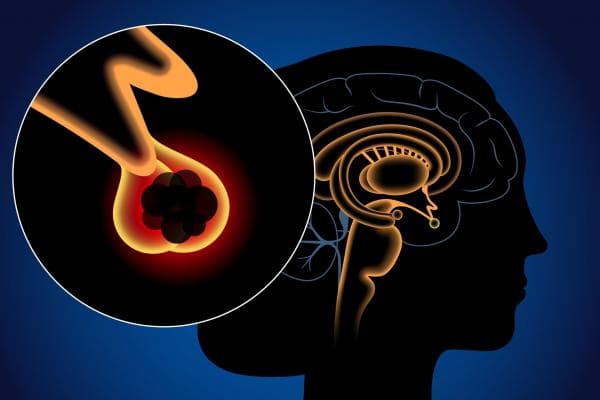 Surgical Treatments Applied in the Pituitary Diseases