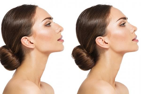 What is Rhinoplasty?