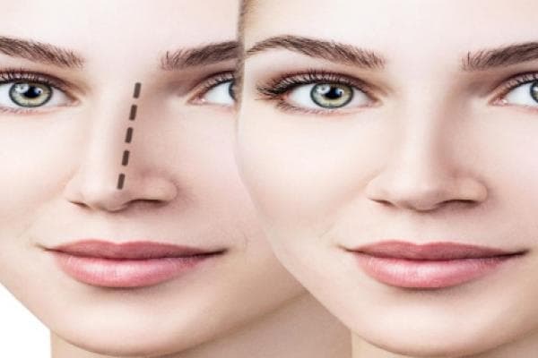 Rhinoplasty