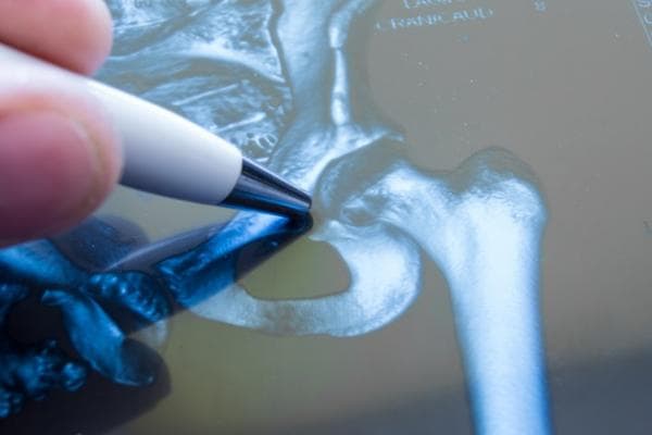 Be Careful in the First 24 Hours of Hip Fractures!