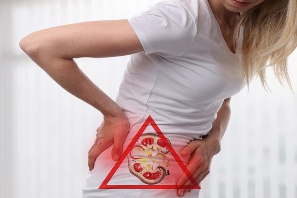 Kidney Stone, Most Common in Men, Started to Appear in Women
